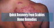 Quick Recovery Scabies Home Remedies