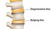 All You Need to Know About Bulging Disc