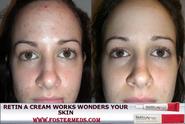 YouKnowItBaby - Know How Retin A Cream Works Wonders On Your Skin