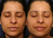 Ensure Complete Betterment From Vitiligo Spots with Benoquin Cream - Health Blog