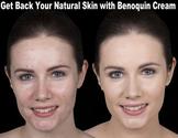 YouKnowItBaby - Get Your Natural Skin Complexion Back with Benoquin Cream