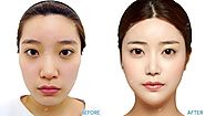 Toxin - Facial Contouring & Thinning of the Jaw | Golden Aesthetics