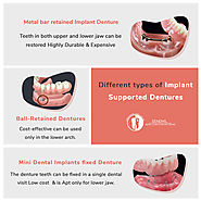 Different types of implant supported dentures