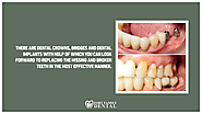 • There are dental crowns, bridges and dental implants with help of which you can look forward to replacing the missi...