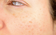 How to Treat and Prevent the Appearance of Age Spots