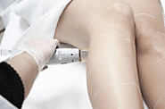 Electrolysis Treatment Over Laser Hair Removal