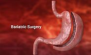 Types of Bariatric Surgery and Recovery After Operatio