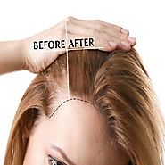 Best PRP Hair Treatment in Dubai, Abu Dhabi & Sharjah | PRP Therapy Cost