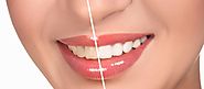 Effective Teeth Whitening Solution For Aspiring Smile