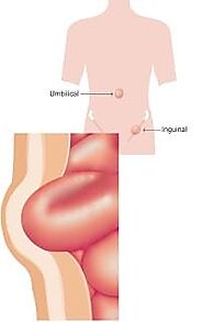 Know Much About Hernia Treatment in Surat