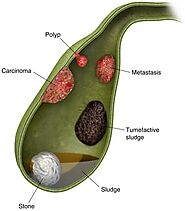 Why People Go For Gallbladder Stone Treatment in Surat For Various Gallbladder Issues?