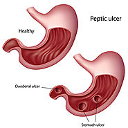 Four Natural Remedies to Avoid Ulcer