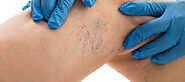 What Are The Various Spider Vein Treatment Options? – Laserskincareae