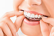 Trends in Invisalign Invisible Braces