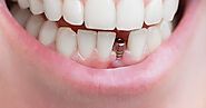 What is the average cost of a single tooth implant in Toronto?
