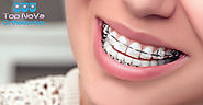 Everything You Need to Know About Adult Orthodontics