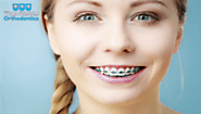 Types of Braces Orthodontic Treatment Offers