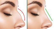 Nose Fillers All You Need To Know - drwongks.com