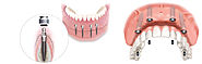 Top, Affordable, Leading Same Day Dental Implants Clinic in Dubai, UAE