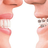 Get The Best Teeth Bonding Treatment With The Dental Bonding Melbourne
