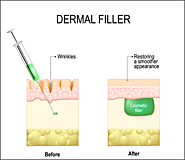 Effectiveness of Dermal Fillers in Removal of Wrinkles and Fine Lines