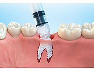 Are your bone is suitable for Dental Implants? – Periodontist in The Woodlands & Conroe, TX