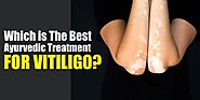 Which Is The Best Ayurvedic Treatment For Vitiligo? - Shuddhi