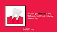 • You can get veneers if your teeth are misaligned, irregularly shaped, etc.