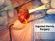 Inguinal Hernia Causes Symptoms and Treatment | Southlake General Surgery