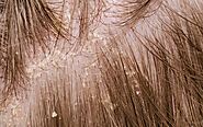 How to Choose a Dry Scalp Treatment
