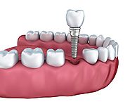 Dental Implants in Ahmedabad | Dental Implant Cost in Ahmedabad