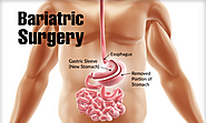 5 Things To Check Before You Undergo Bariatric Surgery In Kolkata-Digestive Surgery Clinic by Ankita Srivastav