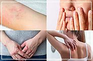 Eczema Causes, Symptoms and Treatment | Health and fitness