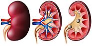Why Should Ayurvedic Treatment for Kidney Failure be the First Choice?