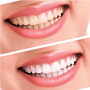 Teeth Whitening in Singapore by Dental Clinic Singapore