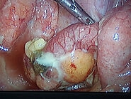The Complete Information About Appendix Operation