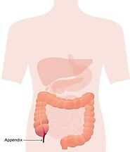 What are appendix operation and its types?