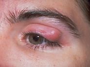 Best Homeopathic Doctor & Treatment of chalazion in India