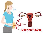 Uterine polyps: Are they an obstacle in pregnancy?