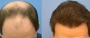 Website at https://www.dynamiclinic.com/hair-transplant/prp-hair-loss-treatment/