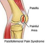 Patellofemoral Pain Syndrome Exercises & Treatment Plan - Your Health Guideline