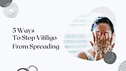 Vitiligo Treatment | 5 Ways To Stop Vitiligo From Spreading
