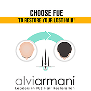 CHOOSE FUE TO RESTORE YOUR LOST HAIR! Alvi Armani