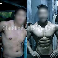 Six pack Abs Liposuction