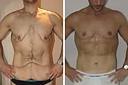 Weight Loss Skin Removal Before And After: Incredible Transformations | Fitness Tones