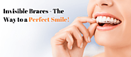 Invisible Braces - The Way to a Perfect Smile!