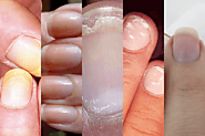 What Your Nails Can Say About Your Health – Best Hospitals in Varanasi