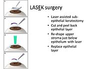 Best LASEK Eye Surgery in Pune | Alternative to LASIK - Dada Laser Eye Institute