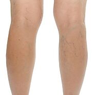 Which Treatment is Best for Varicose Veins in Dubai, Abu Dhabi & Sharjah | Enfield clinic