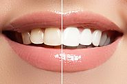 What is the best kit for whitening your teeth at home? - Smile Fit